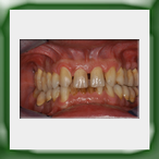 Quadranti in lega aurea e ceramica-1B