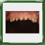 Circolare in lega aurea e ceramica-1A