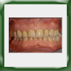 Circolare in lega aurea e ceramica-1B