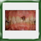 Corona lega aurea e ceramica-1A