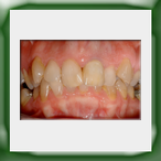 Corona lega aurea e ceramica-1B