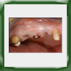 Ponte in lega aurea e ceramica-1A