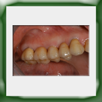 Ponte in lega aurea e ceramica-1B