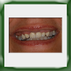 Frontale in lega aurea e ceramica-1A