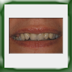 Frontale in lega aurea e ceramica-1B