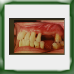 Ponte in lega aurea e ceramica su intarsi-1A