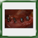 Ponte in lega aurea e ceramica-2A