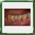 Ponte in lega aurea e ceramica-2B