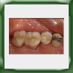Ponte su denti rizotomizzati in lega aurea e ceramica-1B
