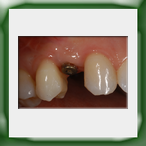 Corona lega aurea e ceramica su impianto-1A