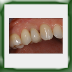 Corona lega aurea e ceramica su impianto-1B