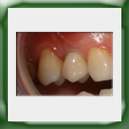 Corona lega aurea e ceramica su impianto-2B