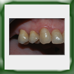 Corone in zirconio-2A